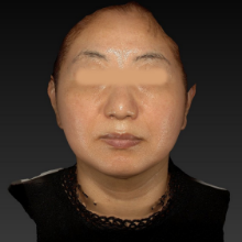 術後1