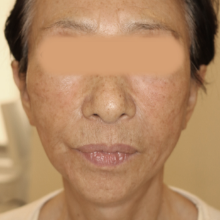 術後2