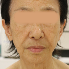 術前2