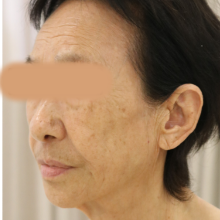 術前4