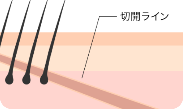 毛包斜切開で傷跡を目立たせない