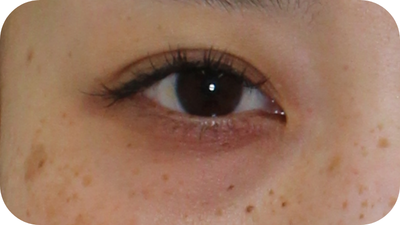 メラニンが原因の茶クマ