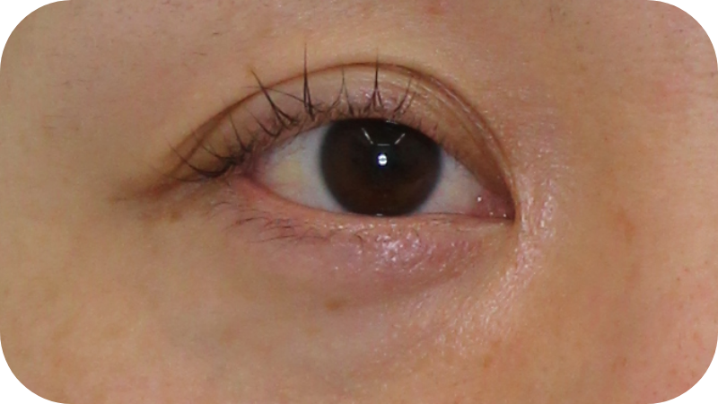 血行不良・眼輪筋の透見に青クマ