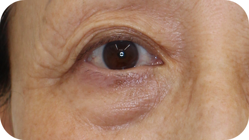 下瞼のたるみによる影クマ