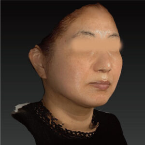 術後1