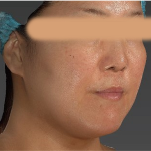 術前3